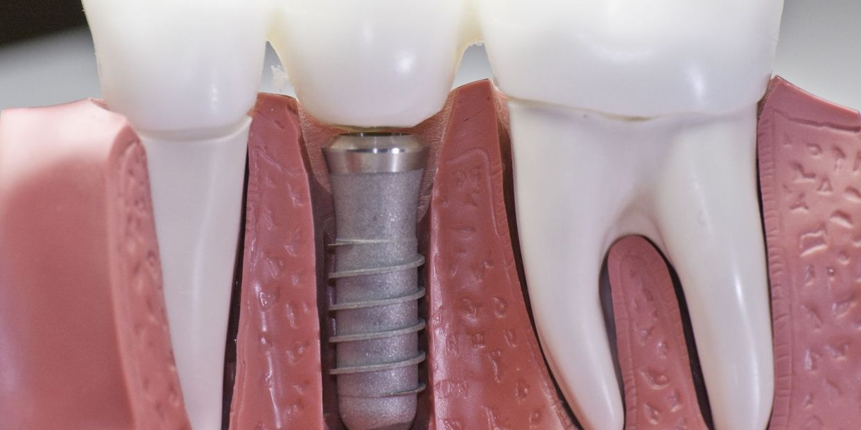 ¿Cuánto cuesta un implante dental?