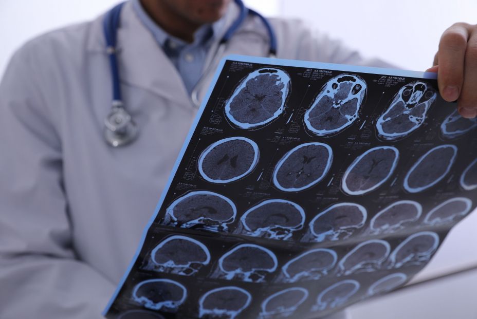 Nuevo hito contra el alzhéimer: un tratamiento elimina las 'células zombi' que inflaman el cerebro