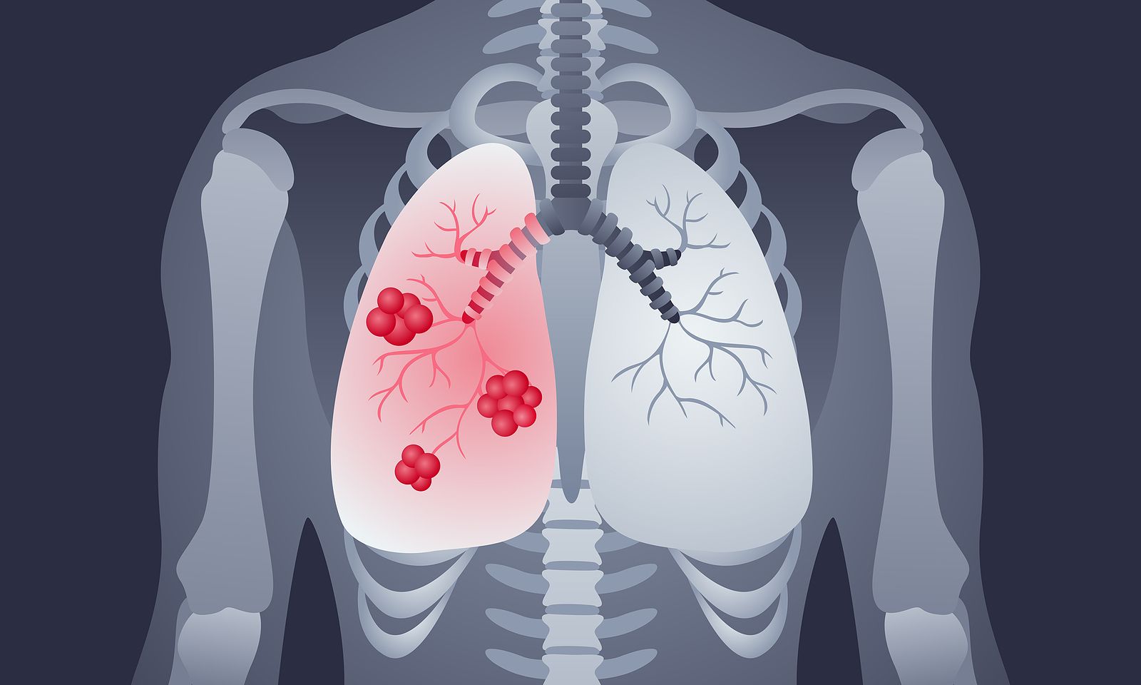Una nueva combinación de fármacos puede mejorar el tratamiento del cáncer de pulmón
