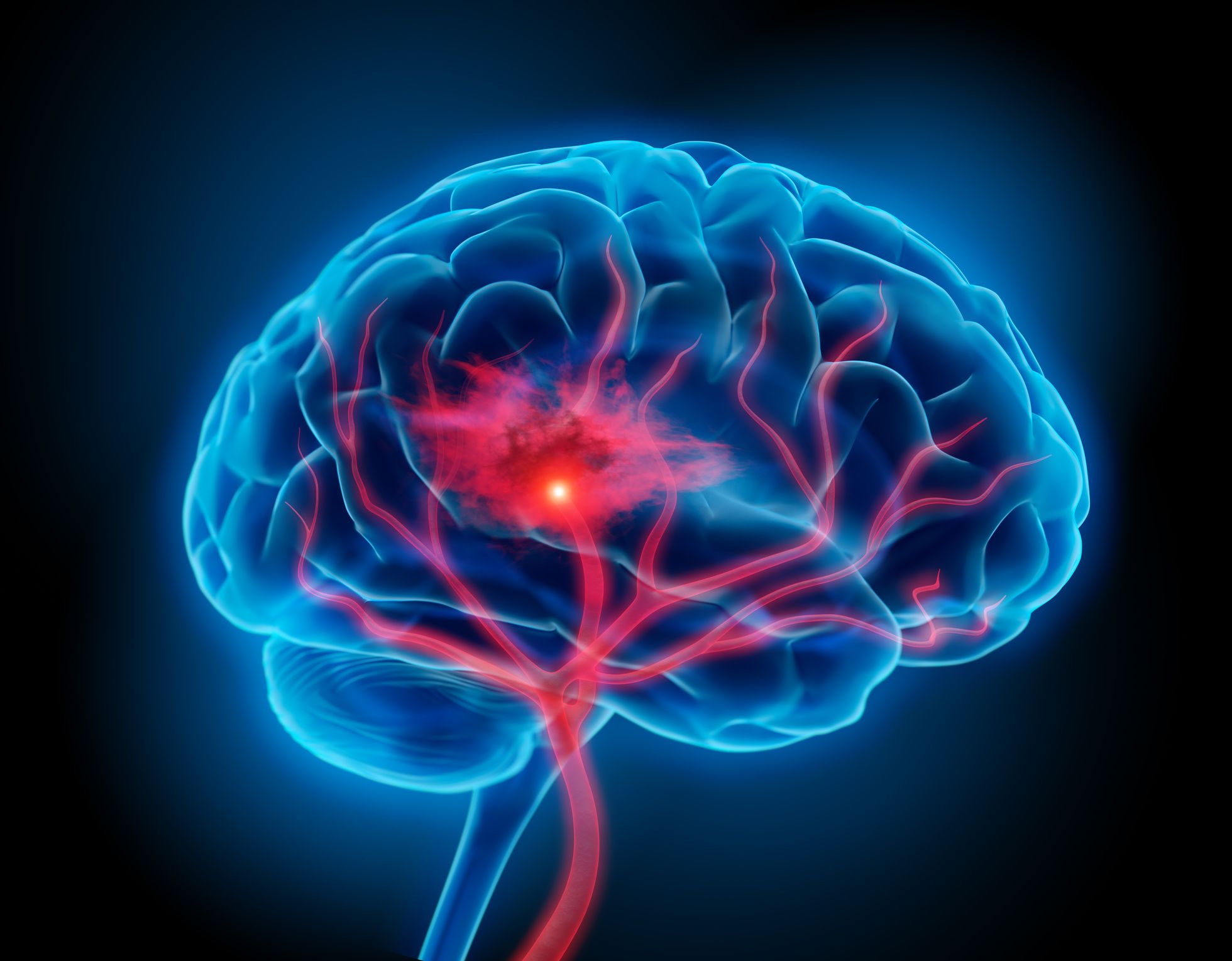 Nueva técnica monitoriza con precisión la evolución del daño en accidentes cerebrovasculares