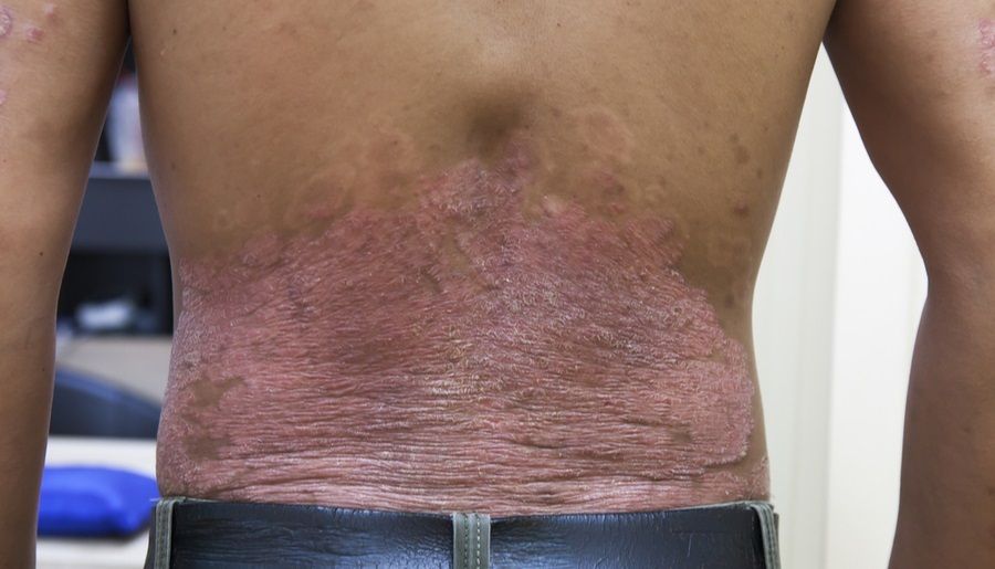 Nuevos avances terapéuticos para la psoriasis pueden posibilitar la remisión completa (Europa Press)