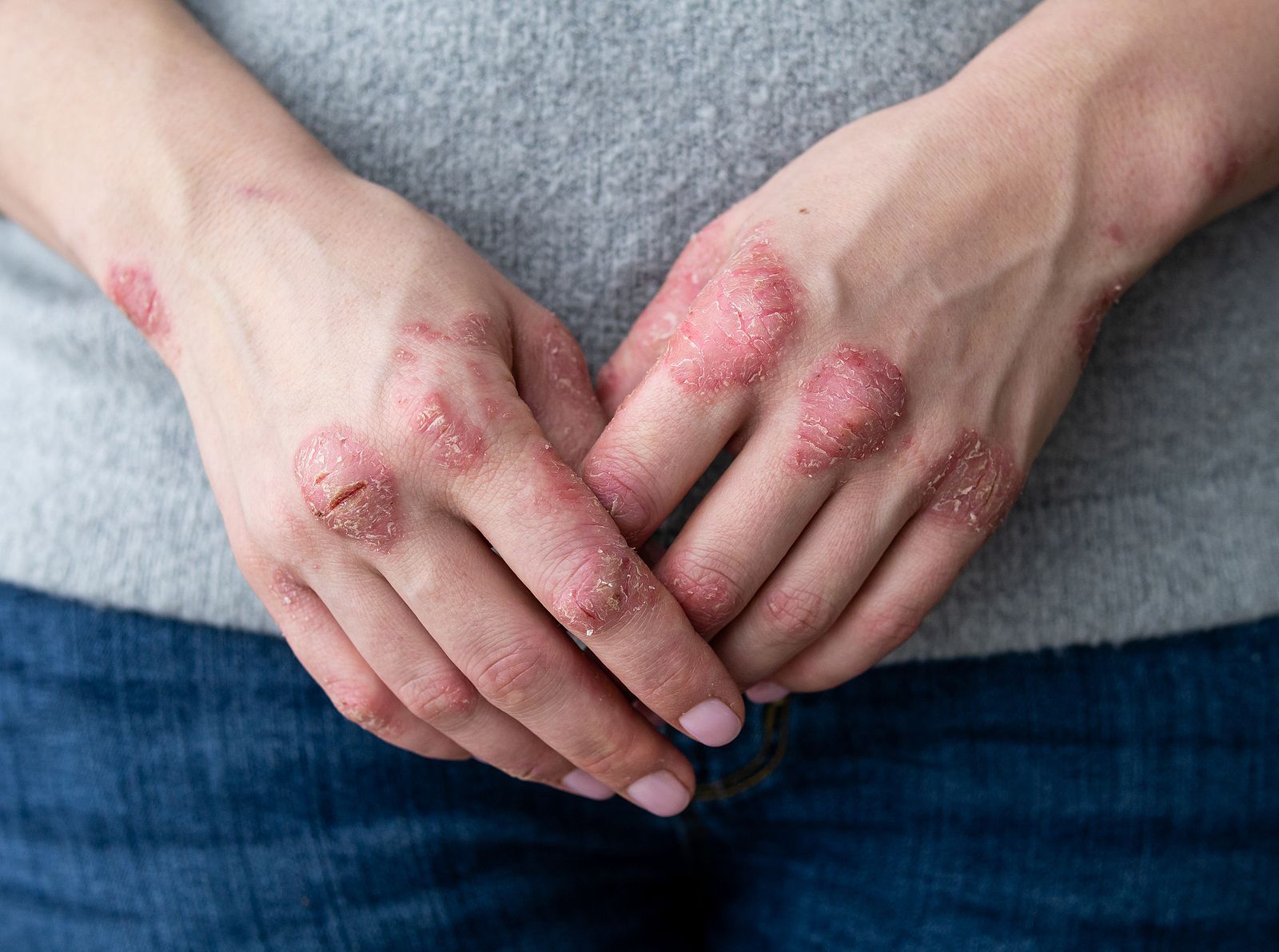 Nuevos avances para la psoriasis permiten la remisión completa en la mitad de los casos