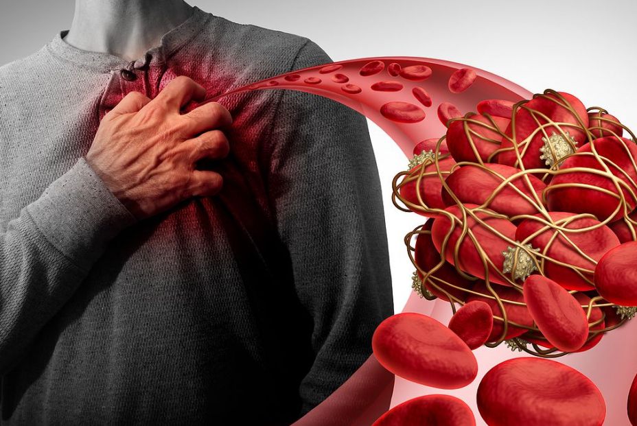 La inclinación de venas pulmonares en el corazón influye al riesgo de trombos (Big Stock)