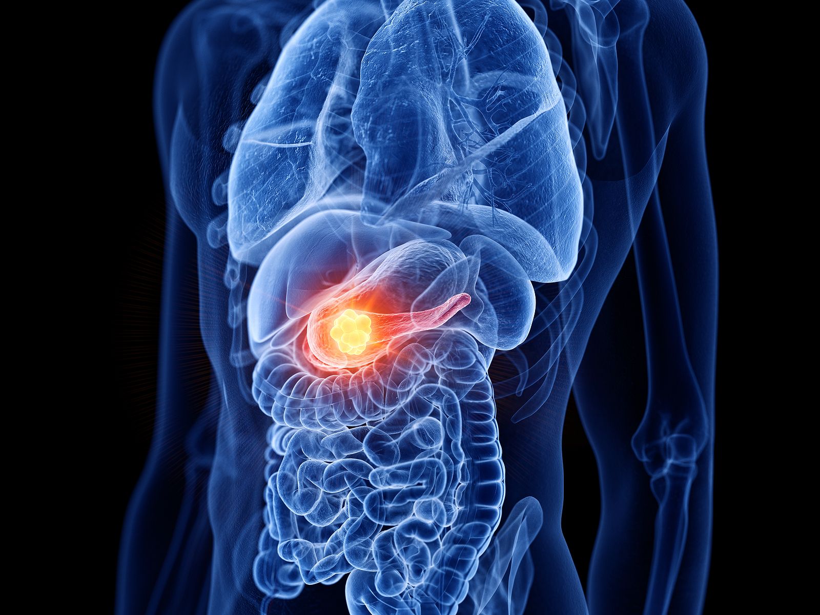 Terapia prometedora en el cáncer de páncreas metastásico, uno de los más agresivos (BigStock)