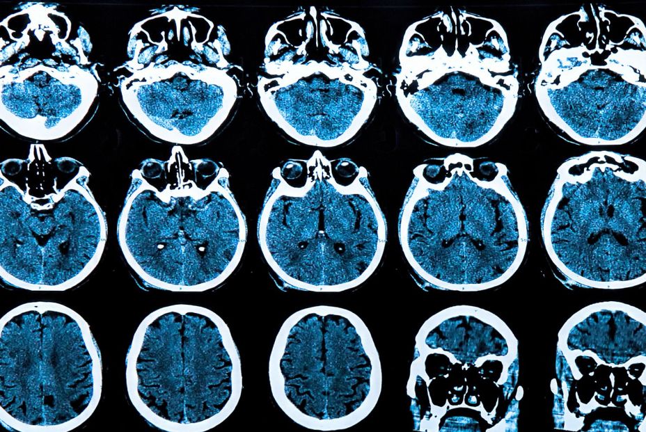 Identifican un biomarcador que permite un diagnóstico diferencial de la demencia frontotemporal (Big Stock)