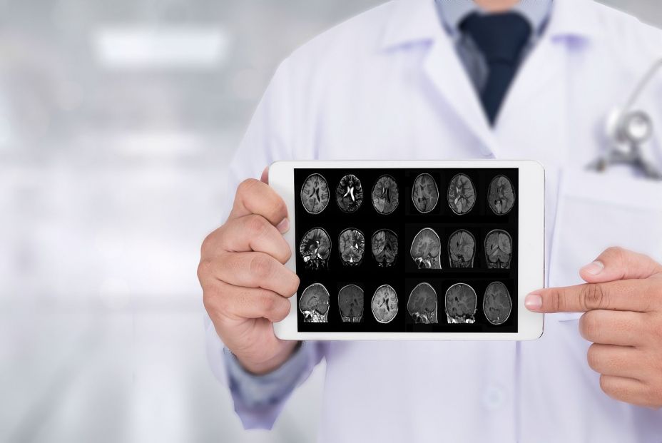 La inteligencia artificial predice el progreso del alzhéimer mejor que las pruebas clínicas