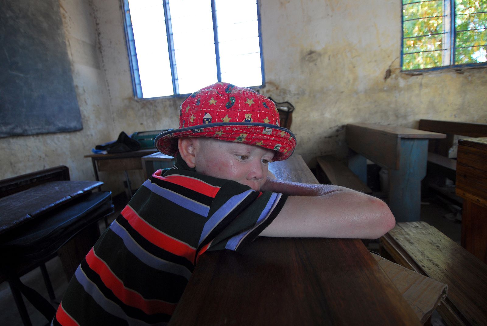 ISDIN extiende su proyecto de ayuda a personas con albinismo a Panamá