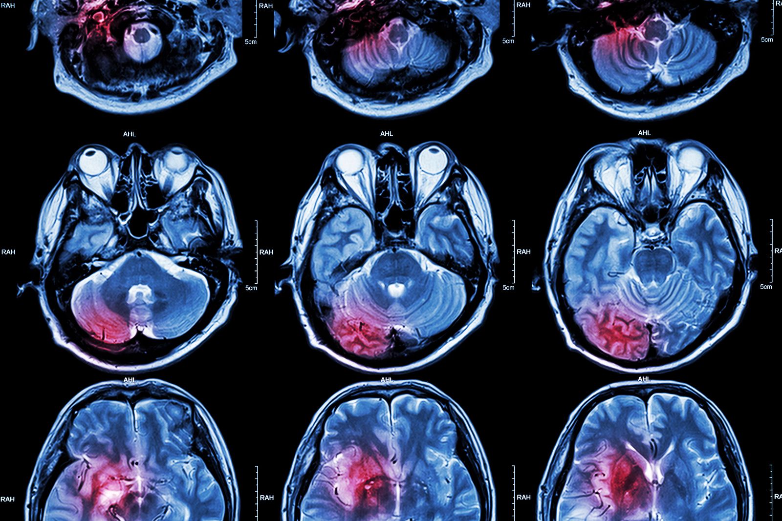 Un antidepresivo se muestra prometedor para el tratamiento de tumores cerebrales