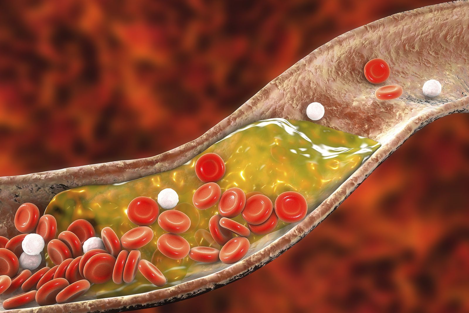 El colesterol elevado está detras del 60% de las enfermedades cardiovasculares