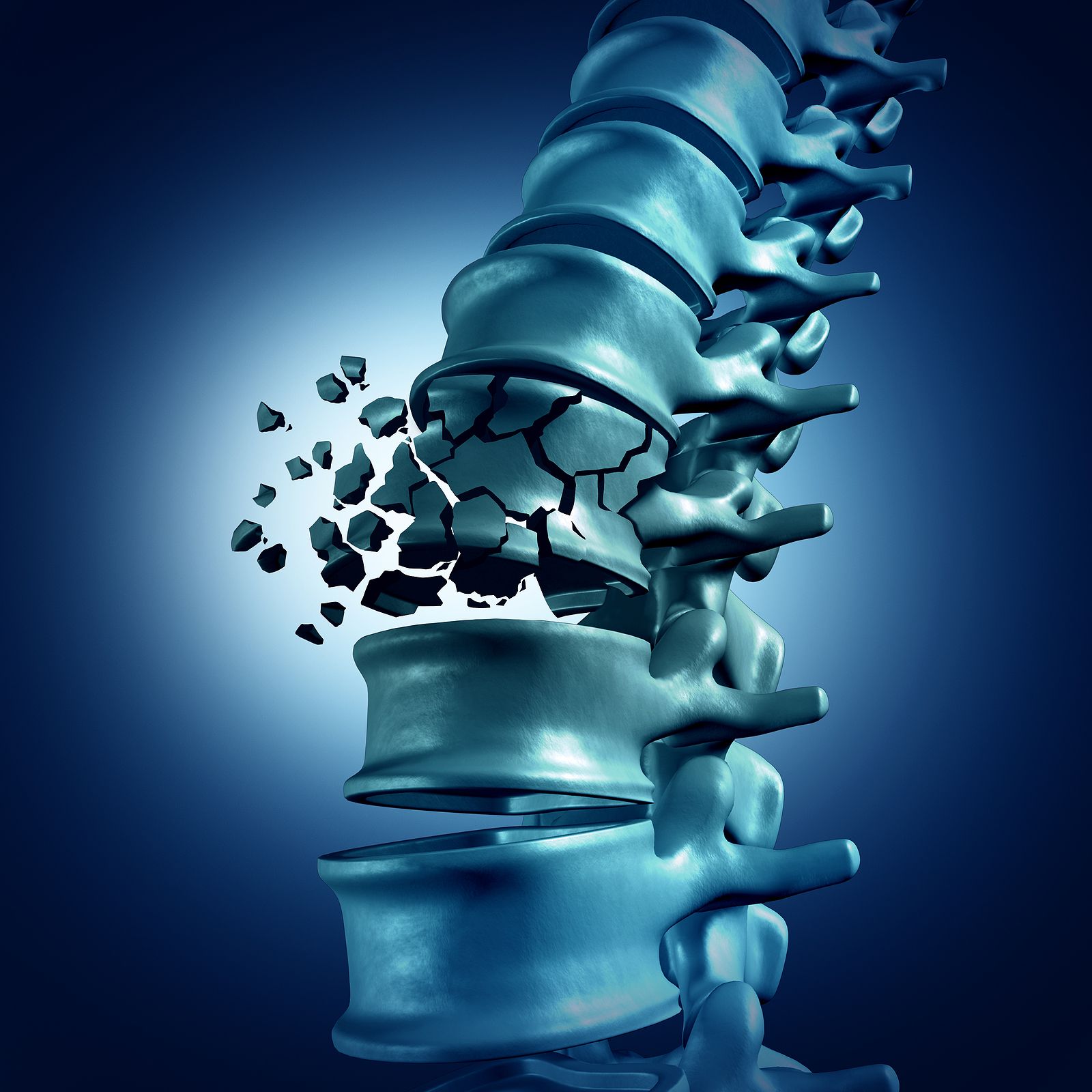 La fractura vertebral multiplica por cinco el riesgo de sufrir otra fractura en la columna