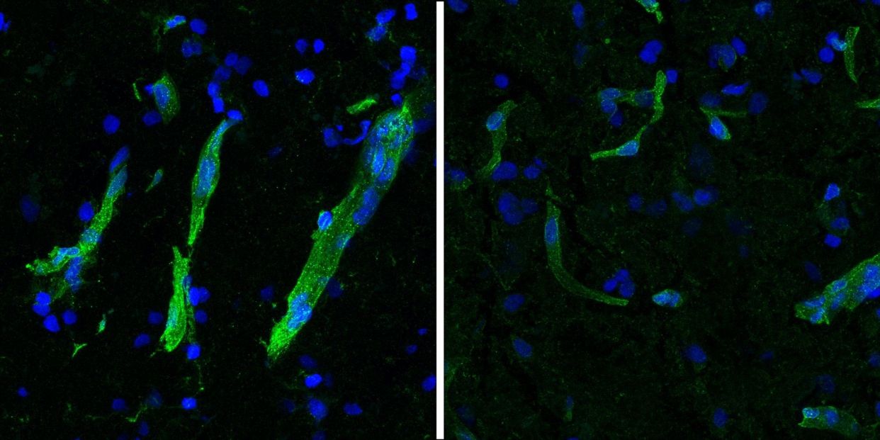 Similitudes celulares y moleculares entre la ELA y la demencia frontotemporal. Fuente: HEIMAN LAB / MIT PICOWER INSTITUTE