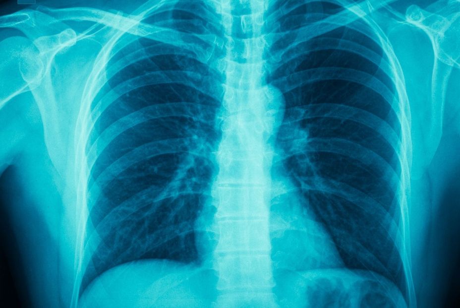 Radiografía de los pulmones. Bigstock