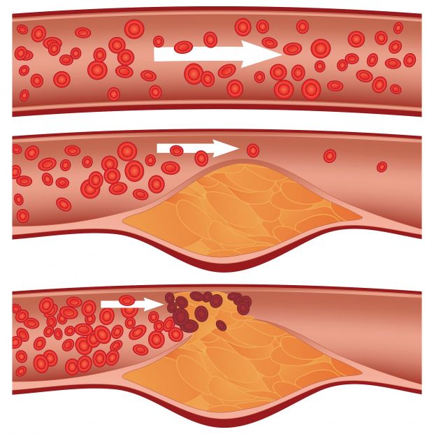 Dibujo explicativo de la obstrucción de las arterias por el colesterol. Fuente: Bigstock