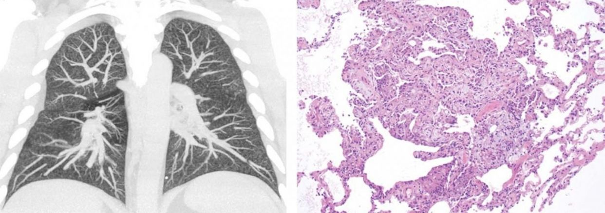 Hallazgos anormales de imágenes clave para el diagnóstico EVALI en vapeadores. Fuente: RADIOLOGICAL SOCIETY OF NORTH AMERICA