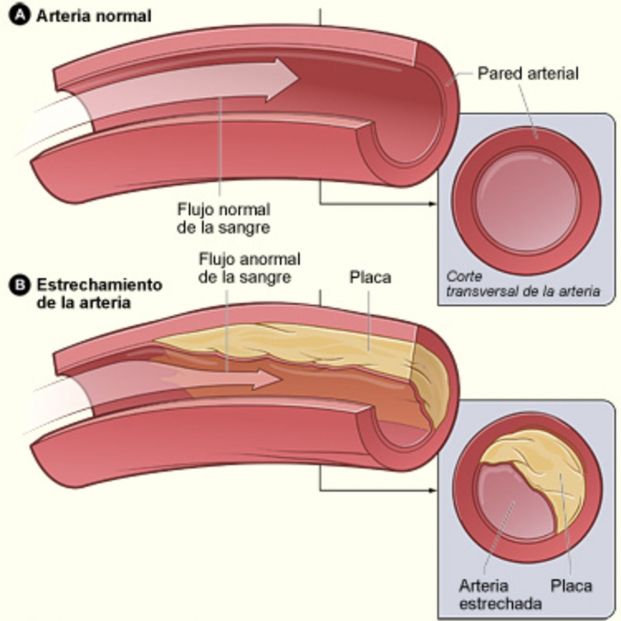 Infografía comparativa entre una arteria normal y otra con arterosclerosis. Fuente: National Heart, Lung and Blood Institute