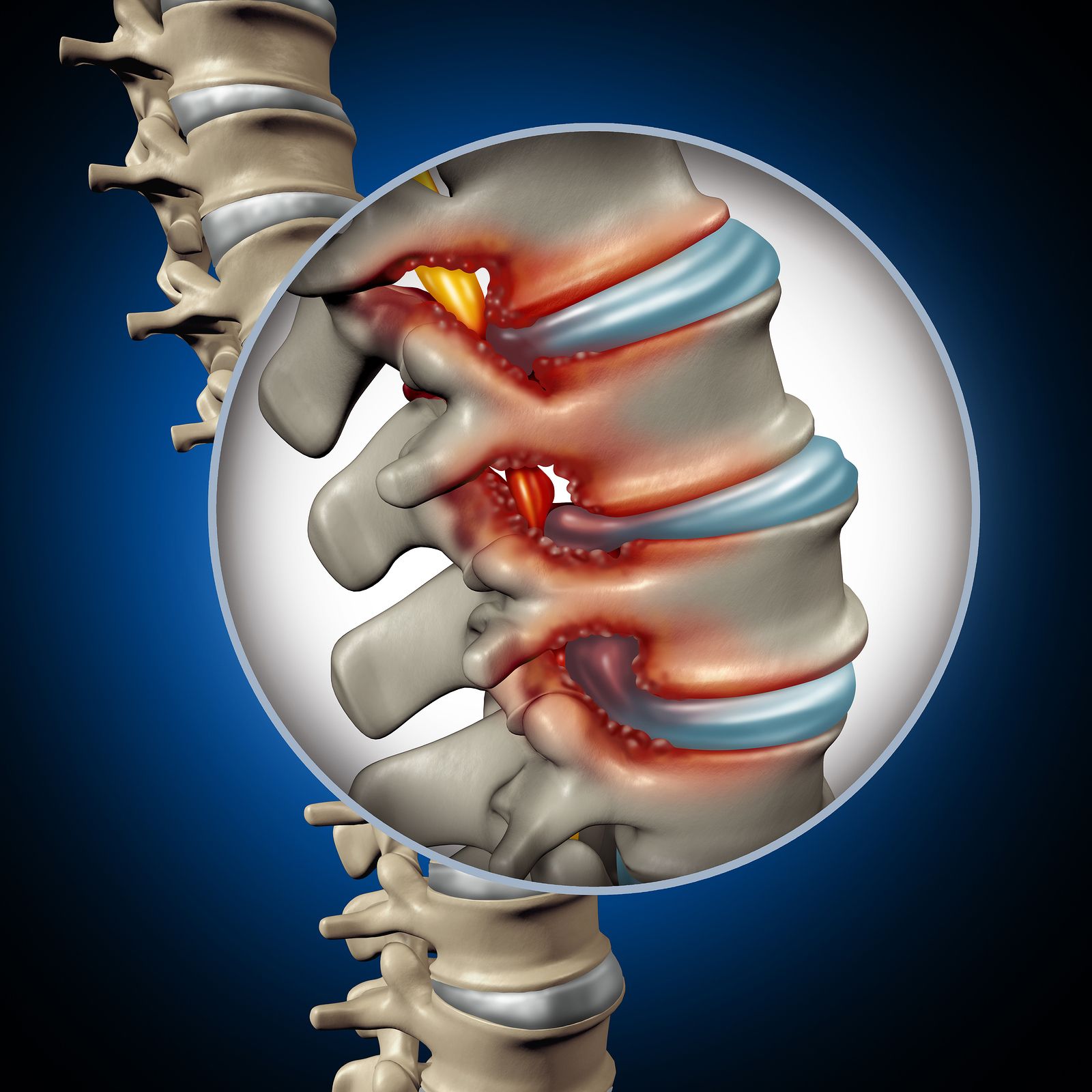 ¿Sabías que la mayoría de las fracturas vertebrales no muestran síntomas? Descubre por qué