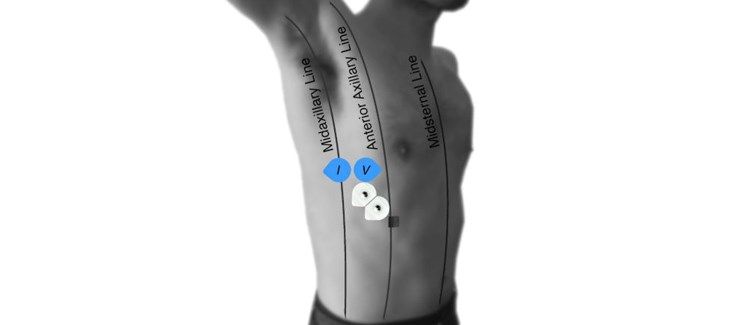 Enfermedades pulmonares