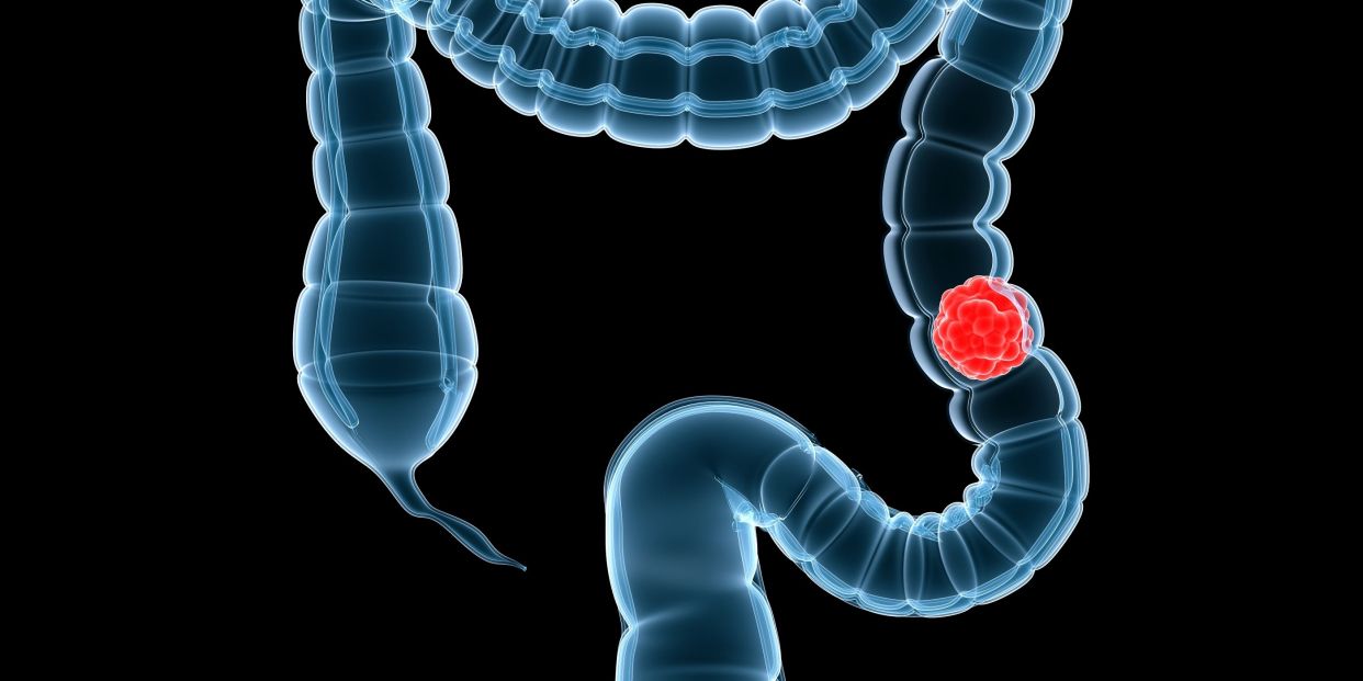 Early symptoms of colon cancer