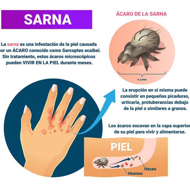 Sarna. Qué se sabemos de esta enfermedad que afecta a la piel 6