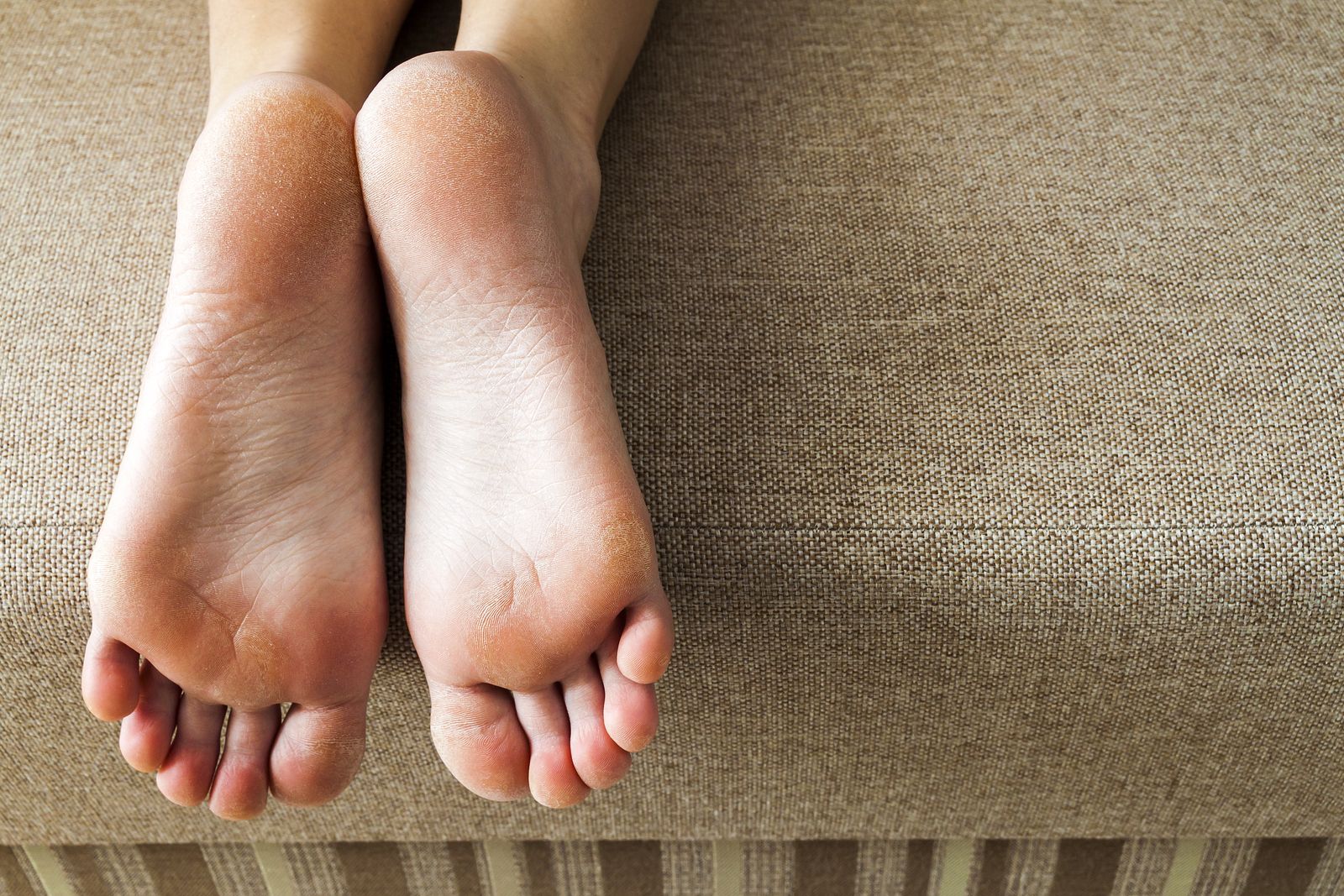 Elimina los callos de tus pies sin dolor: 6 remedios rápidos y sencillos, Estilo de Vida Belleza